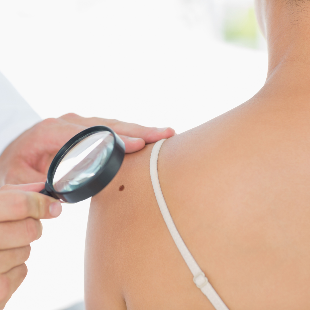 ABCDE rule for moles