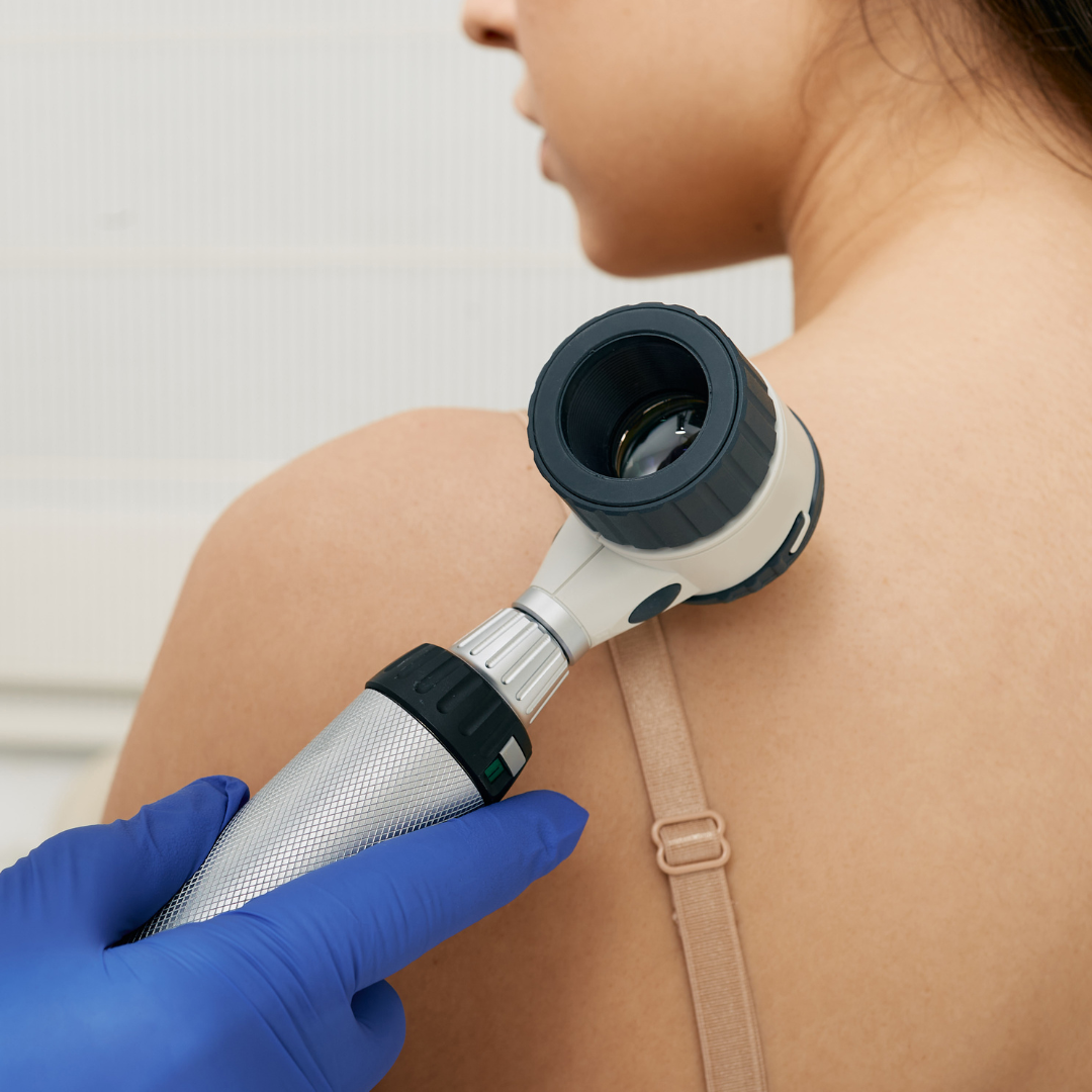 how often to check moles